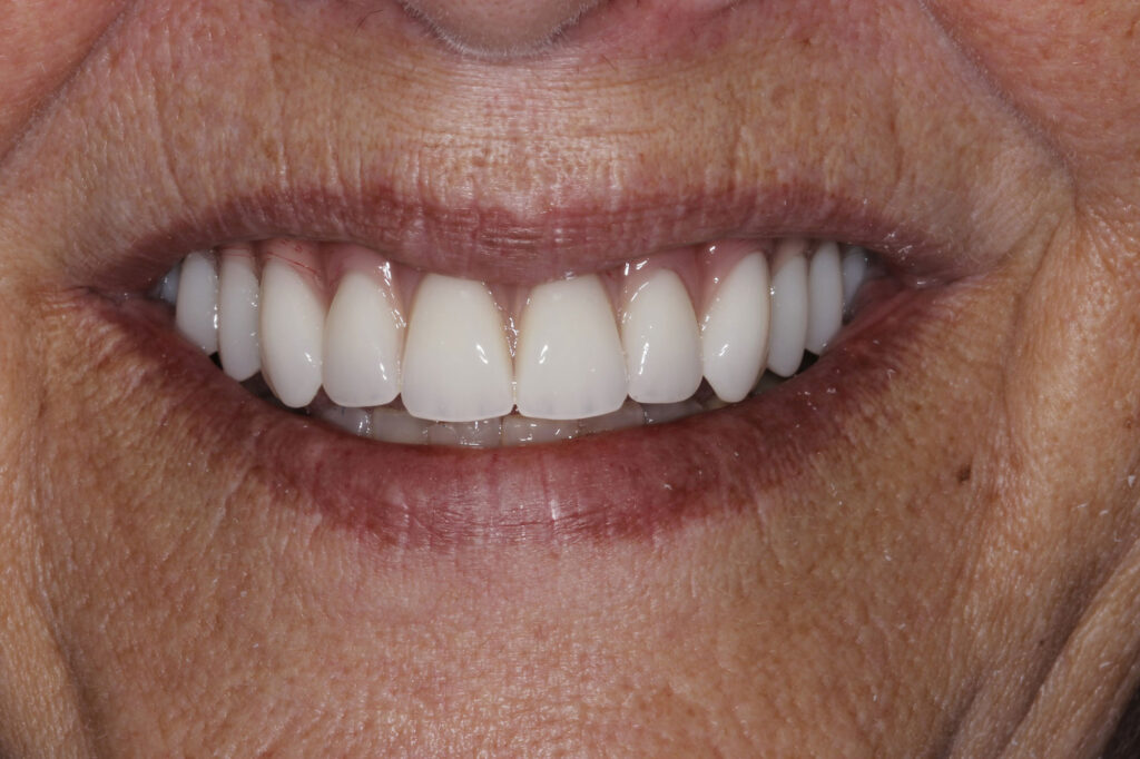 Smile restored after restorative dental treatments in Herndon.